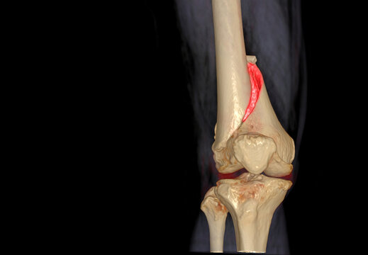 CT knee 3D rendering image AP view isolated on black background showing fracture Femur bone.