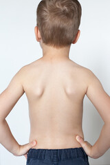 Anatomy Of The Bend Of The Spine In Scoliosis, Correction Of Posture. Chiropractic treatment, back pain relief. Curvature of the spine in children