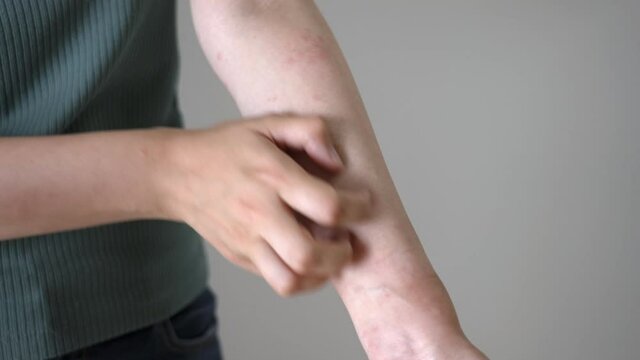 腕に出た湿疹を掻きむしる女性