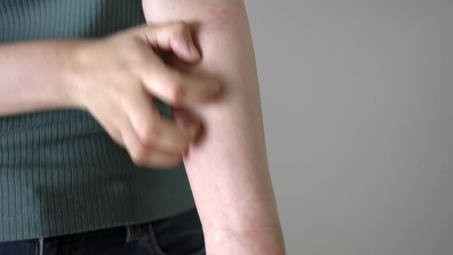 腕に出た湿疹を掻きむしる女性