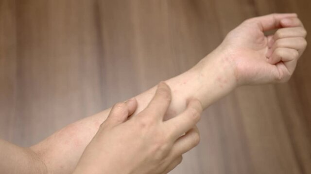 腕に出た湿疹を掻きむしる女性