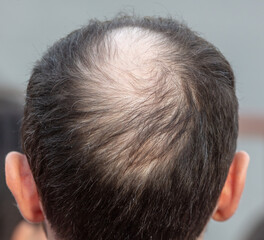 Close-up of a bald spot on a man's head.