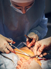 Close up of medical workers hands in sterile gloves stitching up wound after plastical surgical operation. Surgeon placing sutures after abdominal plastic surgery, assistant using medical instruments