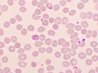 Malaria parasite in red blood cells, ring form stage of Plasmodium falciparum, original...
