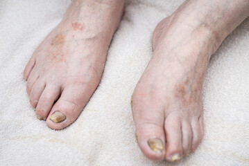 Fungus Infection on Nails of Man's Foot.White background,indoors image.