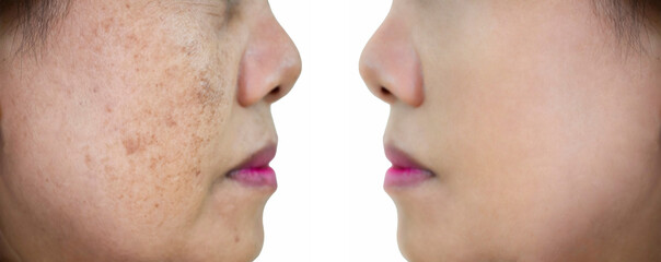 Obraz premium Image before and after dark spot wrinkle melasma pigmentation skin facial treatment on face asian woman.Problem skincare and beauty concept. 