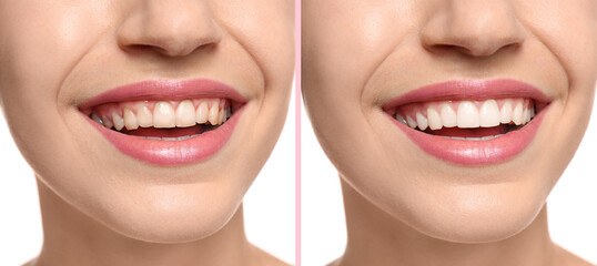 Collage with photos of woman before and after teeth whitening, closeup. Banner design