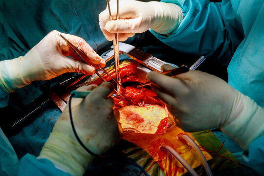 Surgeon Surgery And Team Perform Thoracic Surgery In Case Lung Cancer