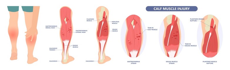 Calf Pain leg back muscle blood vessels nerve acute sport damage arterial trauma tennis soccer tear Cramp spasm Charley horses medial fiber bruising run walk tendon Clot deep vein pull torn up sprain © Pepermpron