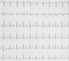 a cardiac EKG printed on paper