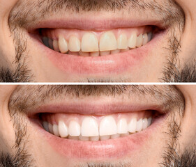 Collage with photos of man before and after teeth whitening, closeup