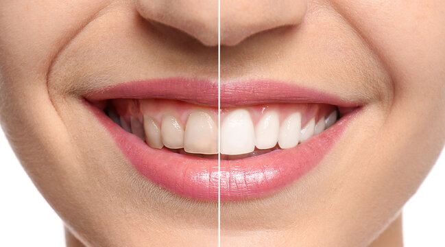 Collage with photos of woman before and after teeth whitening, closeup. Banner design