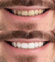 Collage with photos of man before and after teeth whitening, closeup