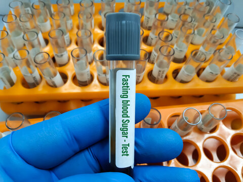 Technician or scientist hold a sample tube of Plasma glucose Fasting (FGP) test. Fasting blood sugar(FBS) for diagnosis hyperglycemia or hypoglycemia in Diabetes Mellitus (DM).Medical testing concept.