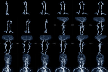 Fototapeta na wymiar MRA and MRI image of blood vessels in brain for a medical diagnosis cerebrovascular or hemorrhagic stroke.