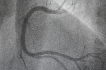 Coronary angiography, Coronary artery disease. Medical x-ray of heart disease. Healthcare and...
