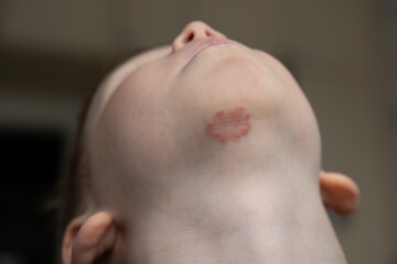 rash on the child's chin in the form of pimples in a circle staphylococcus
