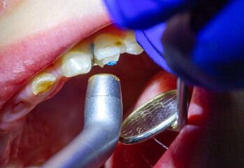 Treatment of baby teeth in a child, dental drill, installation and filling of canals, sealant and photopolymer filling.
