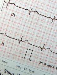ECG output printout of a Heart rate or pulse wave measurement equipment in a hospital