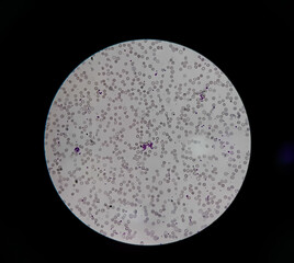 Microcytic hypochromic anaemia and immuno haemolytic anaemia, close view,platelet clamping view