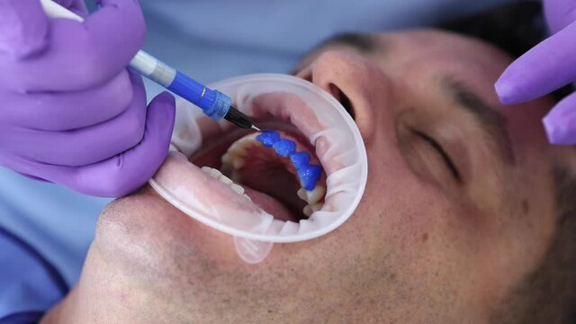 Dentist applying gel for protection enamel from caries