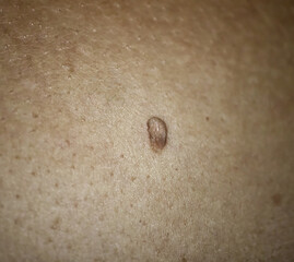 Large Papilloma on woman skin. Medical health photo. Dermatology problem. Close-up