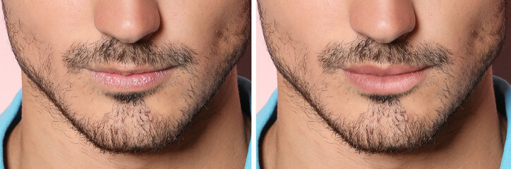 Collage with photos of man before and after lips augmentation, closeup. Banner design