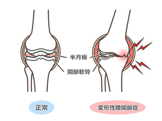 変形性膝関節症 O脚のおじいさん Wall Mural Wallpaper Murals K Nakano
