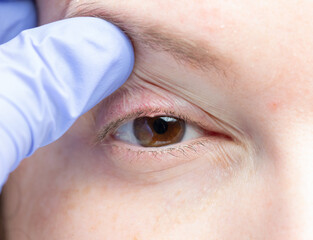 close up of a woman's eye with a bacterial infection of an oil gland in the lower eyelid.