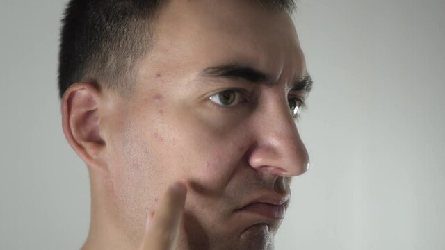 Worried adult man looks in mirror, examining acnes and zits on face. Unhappy man dissatisfied with skin condition. Adult person has problem skin with acnes and zits.
