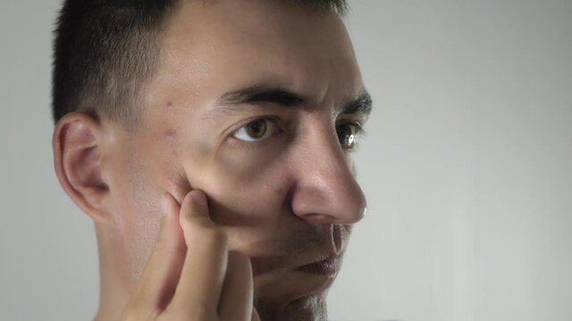 Worried adult man looks in mirror, examining acnes and zits on face. Unhappy man dissatisfied with skin condition. Adult person has problem skin with acnes and zits.