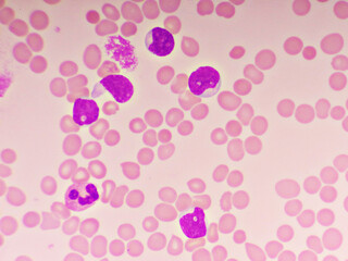Picture of acute lymphocytic leukemia or ALL cells in blood smear, analyze by microscope, 1000x