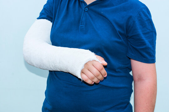 Boy with broken arm, plaster on arm as therapy.