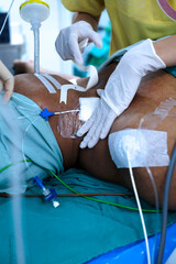 anesthetist setting central venous catheter to patient before open heart surgery