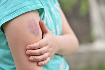 The child is holding on to a large bruise on his arm - obrazy, fototapety, plakaty