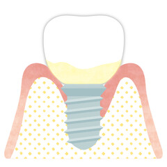 インプラント歯周炎（軽度）