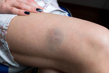 Female leg with a large bruise, domestic violence concept.