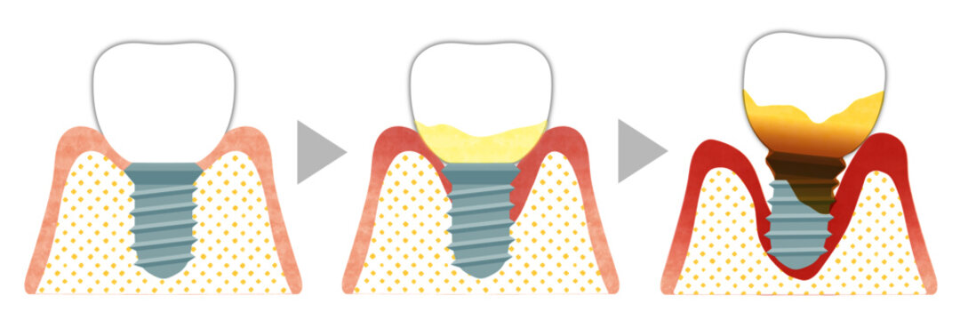 インプラント歯周炎の流れ