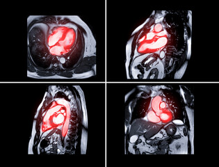 Collection of MRI heart or Cardiac MRI magnetic resonance imaging of heart  for diagnosis heart disease.
