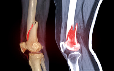 CT knee joint 3D rendering image lateral view and Sagittal view isolated on black background showing fracture Femur bone.