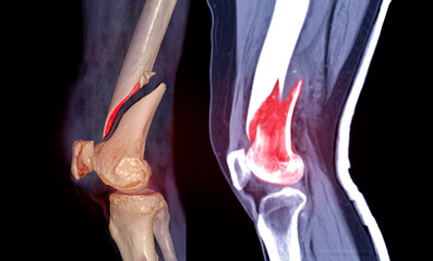 CT knee joint 3D rendering image lateral view and Sagittal view isolated on black background...