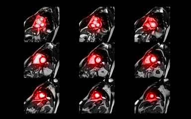 MRI heart or Cardiac MRI magnetic resonance imaging of heart in short axis view showing cross-sections of the left and right ventricle for detecting heart disease.