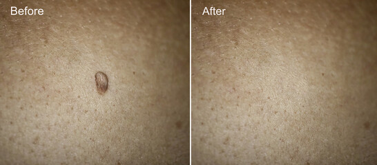 Photo Before and After removal of Large Papilloma on woman skin. Papilloma removal concept....