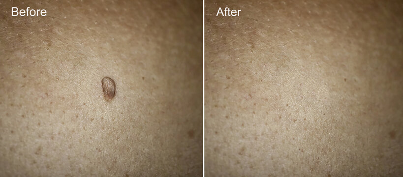 Photo Before and After removal of Large Papilloma on woman skin. Papilloma removal concept. Selective focus