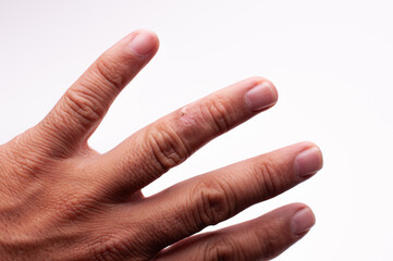 finger of hand with plaque scleroderma morphea, extended fingers