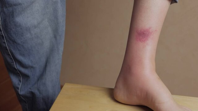 Close-up of an abscess from an insect bite on a woman's leg. A woman treats the wound.