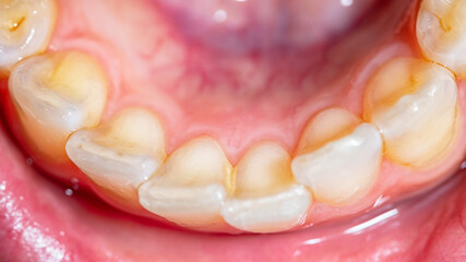 Lower dental arch full of plaque. Layer of bacterial plaque around the dental collar close to the...