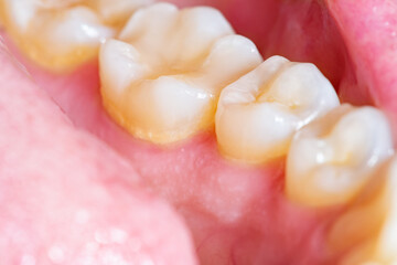 Lower dental arch full of plaque. Layer of bacterial plaque around the dental collar close to the...