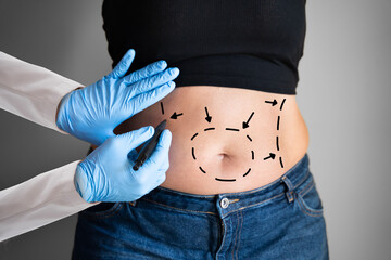Abdominoplasty Obesity Surgery
