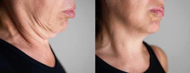 Double Chin Face Plastic Surgery - obrazy, fototapety, plakaty